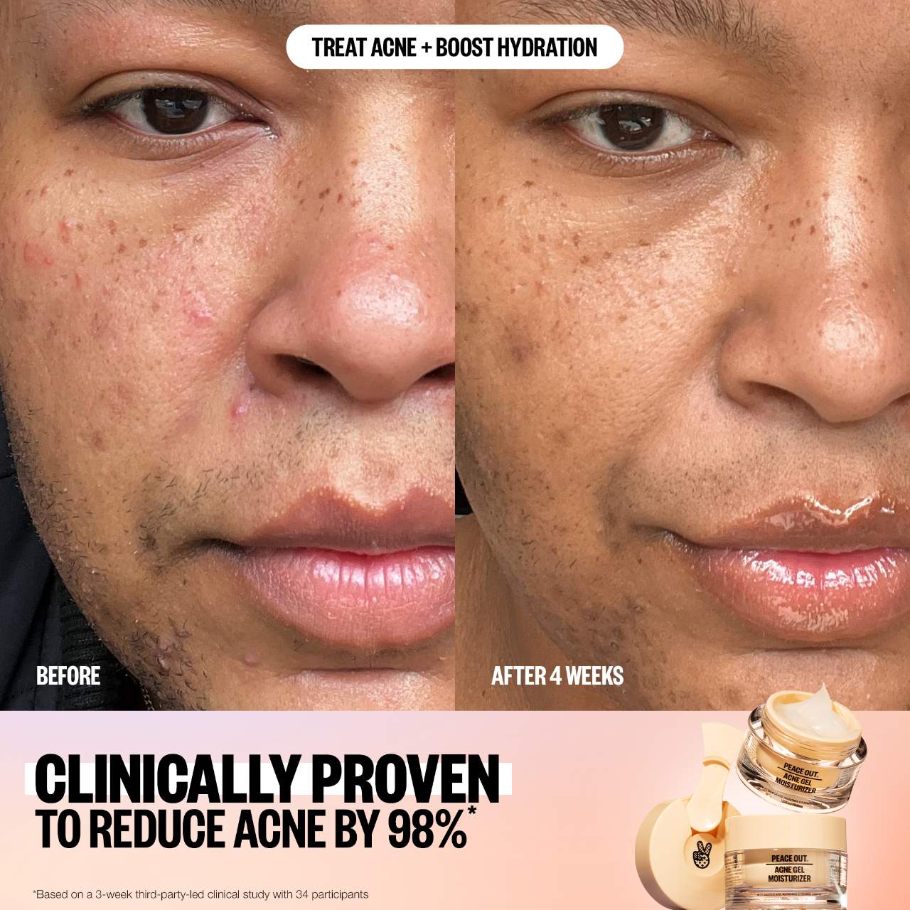 PEACE OUT☆ニキビケア美容液☆Salicylic Acid Acne Treatment 81DuVq7hdlL._UF1000,1000_QL80_.jpg